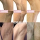 Diode laser hair removal  Permanent hair reduction  Diode laser skin treatment  Laser hair removal